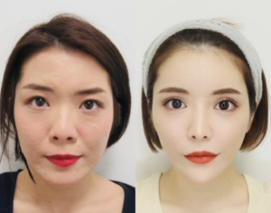 【画像比較】妹尾ユウカの整形前と整形後！総額1000万円超え！？ – トレンド情報 まりこBLOG